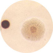 유레아플라즈마 (Ureaplasma Urealytium)