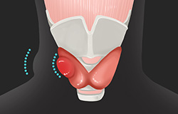 갑상선 질환