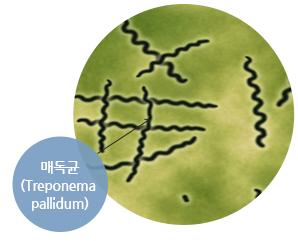 매독균